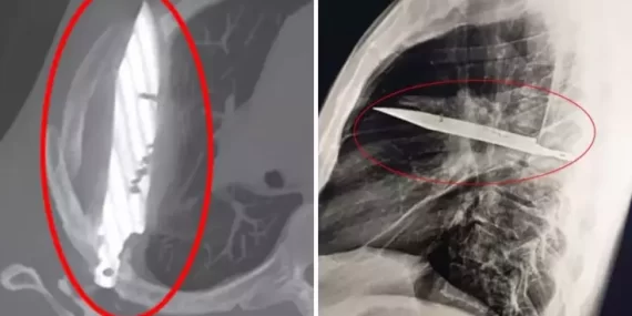 Göğüs ağrısıyla hastaneye gitti, göğsünde 8 yıldır bıçakla yaşadığı ortaya çıktı!