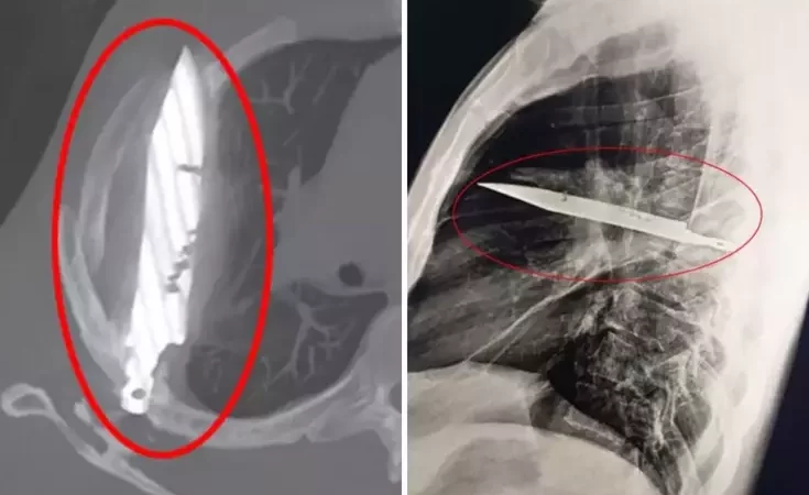 Göğüs ağrısıyla hastaneye gitti, göğsünde 8 yıldır bıçakla yaşadığı ortaya çıktı!